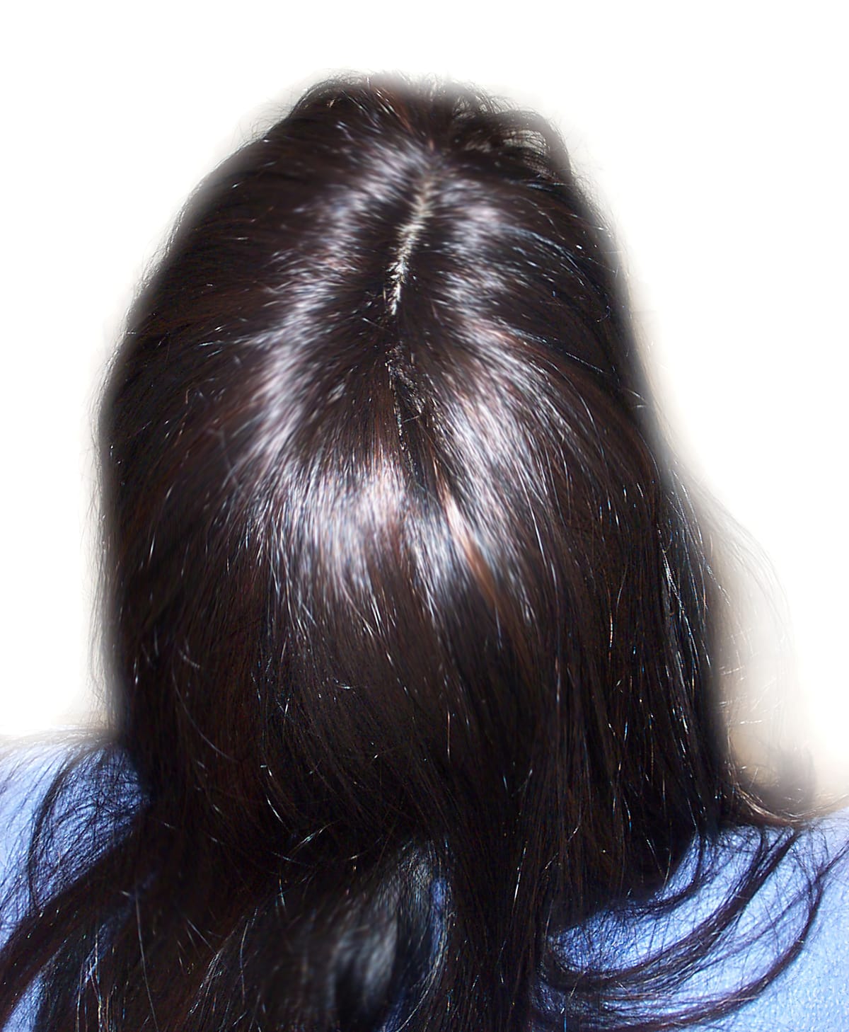 After Picture - Androgenetic Alopecia